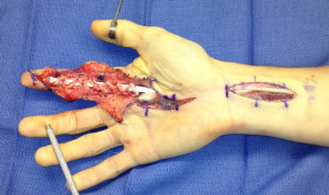 Finger tendon graft surgery, off the bike for a while-photo.jpg