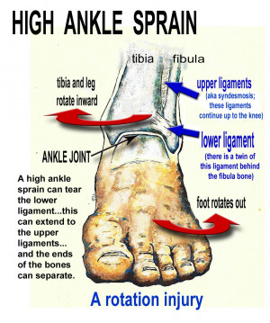 High ankle sprains are less common than low ankle sprains, but this ...