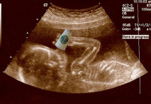 Starbucks Ultrasound