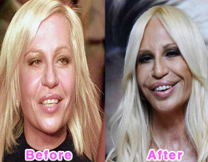 16 Worst Celebrity Plastic Surgery Disaster
