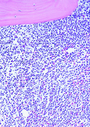 Blood Journal Evidence of increased angiogenesis in patients with