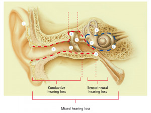 Different Types Hearing Loss