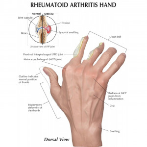 Rheumatoid Arthritis Hand Model