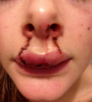 ... shares injuries after her boyfriend bites her lip in violent attack