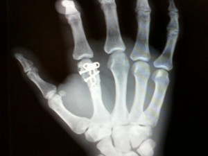 Broken Hand X ray