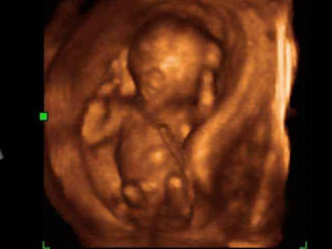 Planned Parenthood: Ultrasounds are “political propaganda”