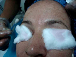 como clarear manchas no rosto, minha dica- como usar acido glicolico ...