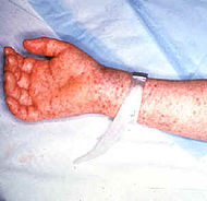 Petechial rash caused by rocky mountain spottedfever on the arm