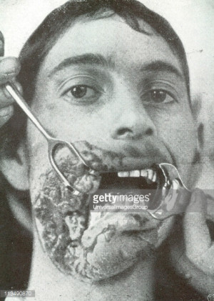 Horror of war: Facial injuries to German soldier in World War I. ...