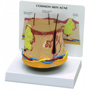 GPI G375 Acne Skin Model