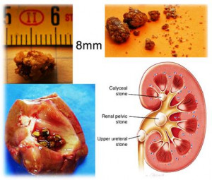 Kidney Stones & Treatment. (INFO IN URDU)