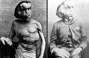 10 People With Shocking and Extreme Deformities