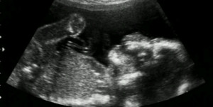 Its a boy!! Funny Ultrasound pic.: Photos, Ultrasound Photo ...