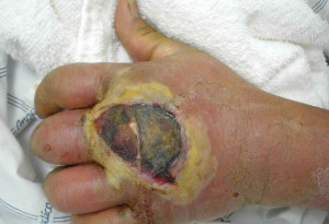 Figure 2. Infection of the hand caused by methicillin-resistant ...