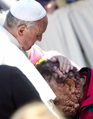 Pope Francis (L) hugs a man with neurofibromatosis in Saint Peter's ...