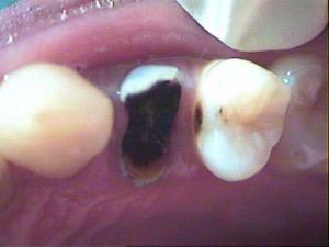 Broken Tooth Extraction