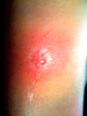 Brown Recluse Spider Bite...