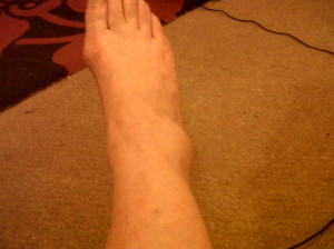 Broken Ankle Pictures