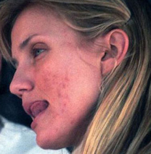 Celebrities with bad skin