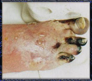 What Gout Looks Like