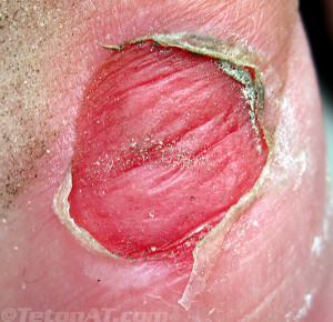 blood blister on skin