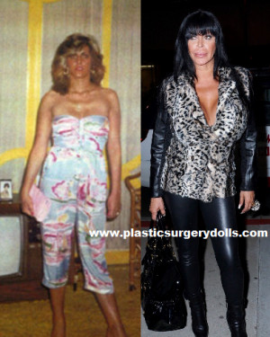 big ang plastic surgery1 Big Ang Gets Whacked