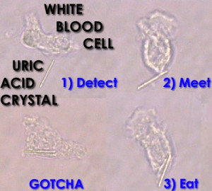 uric acid crystals gout