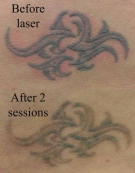 Quote A Number Of Different Reasons For Removing Tattoo Like Picture