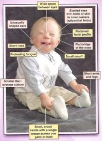 Children with Down Syndrome have a wide space between eyes, slanted ...