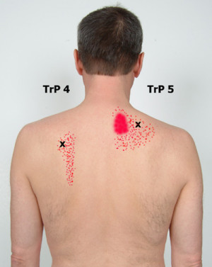Trapezius Muscle Pain From Swimming
