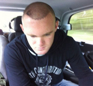 Wayne Rooney's hair transplant new hair