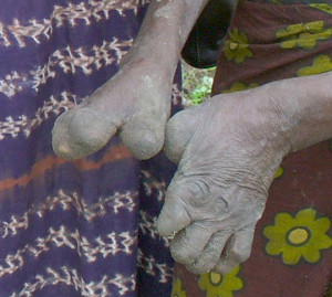 Leprosy Pictures Symptoms...