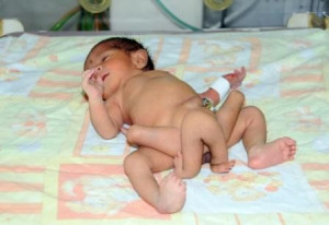 BABY WITH SIX LEGS BORN IN PAKISTAN