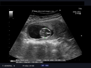 13 Week Ultrasound Down Syndrome