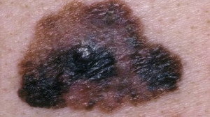 70860696_melanoma_skin_cancer.jpg