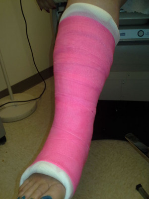 Her Broken Ankle Cast