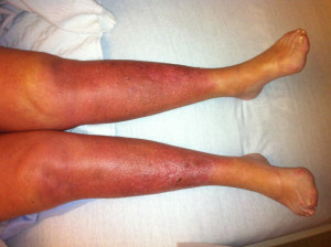 Clinical manifestations of venous insufficiency