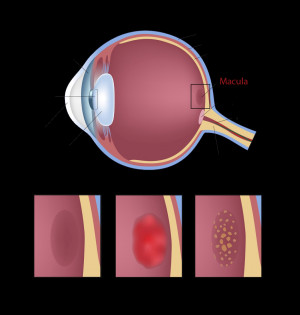 It's not clear what causes wet macular degeneration. The condition ...