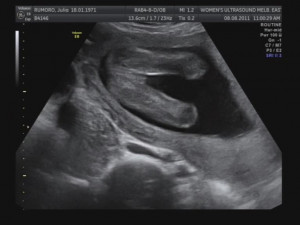Baby Girl Ultrasound at 19 Weeks