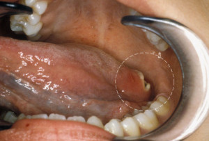 Pics, Images, Pictures and Photos of Mouth Cancer