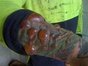 TATTOO REMOVAL NIGHTMARES