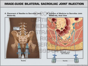 Bilateral Sacroiliac Joint Injection
