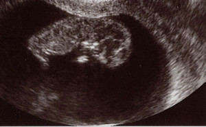 Related Pictures ultrasound pictures first trimester baby