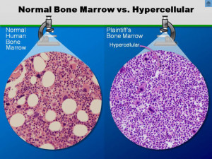Normal Bone Marrow