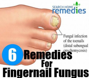 ... www.searchhomeremedies.com/top-5-home-remedies-for-fingernail-fungus