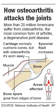 ... joint injection technique knee exercises knee replacement surgery pain