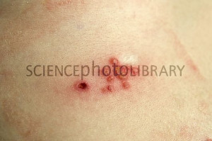 Related Pictures shingles symptoms contagious