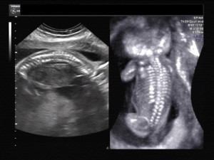 Ultrasound images of anomalies of fetal spine