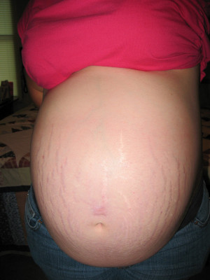 Belly Piercing with Stretch Marks