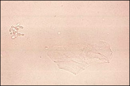 yeast hyphae urine sediment